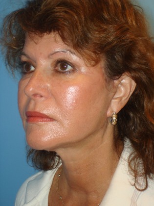 Facelift_-_Case_4_-_After_2__20020417172549794__20070614132913681_large