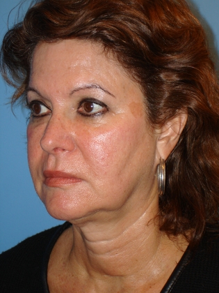Facelift_-_Case_4_-_Before_2__20020417172549794__20081104161204975_large