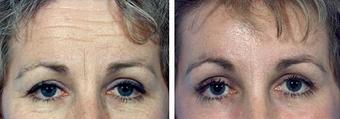 Forehead-Lift-before-652135-808062