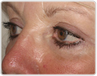 bt-blepharoplasty-after