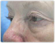 bt-blepharoplasty-before