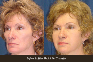 before-and-after-facial-fat-transfer