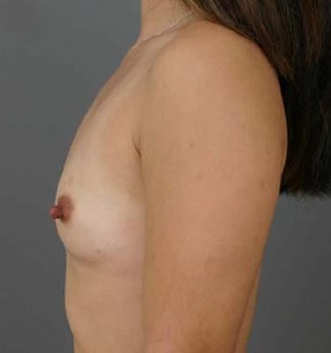 breast-surgery_p2_1a