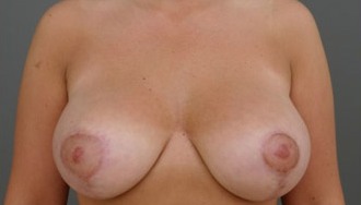 breast-surgery_p3_2b