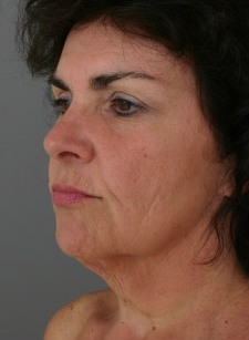 facial_rejuvenation_p5_2a