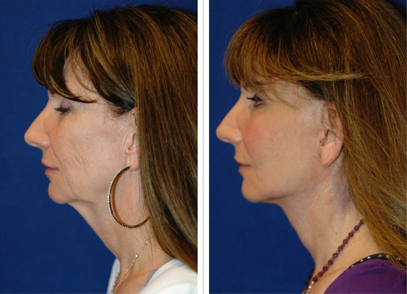 necklift-before-and-after-4